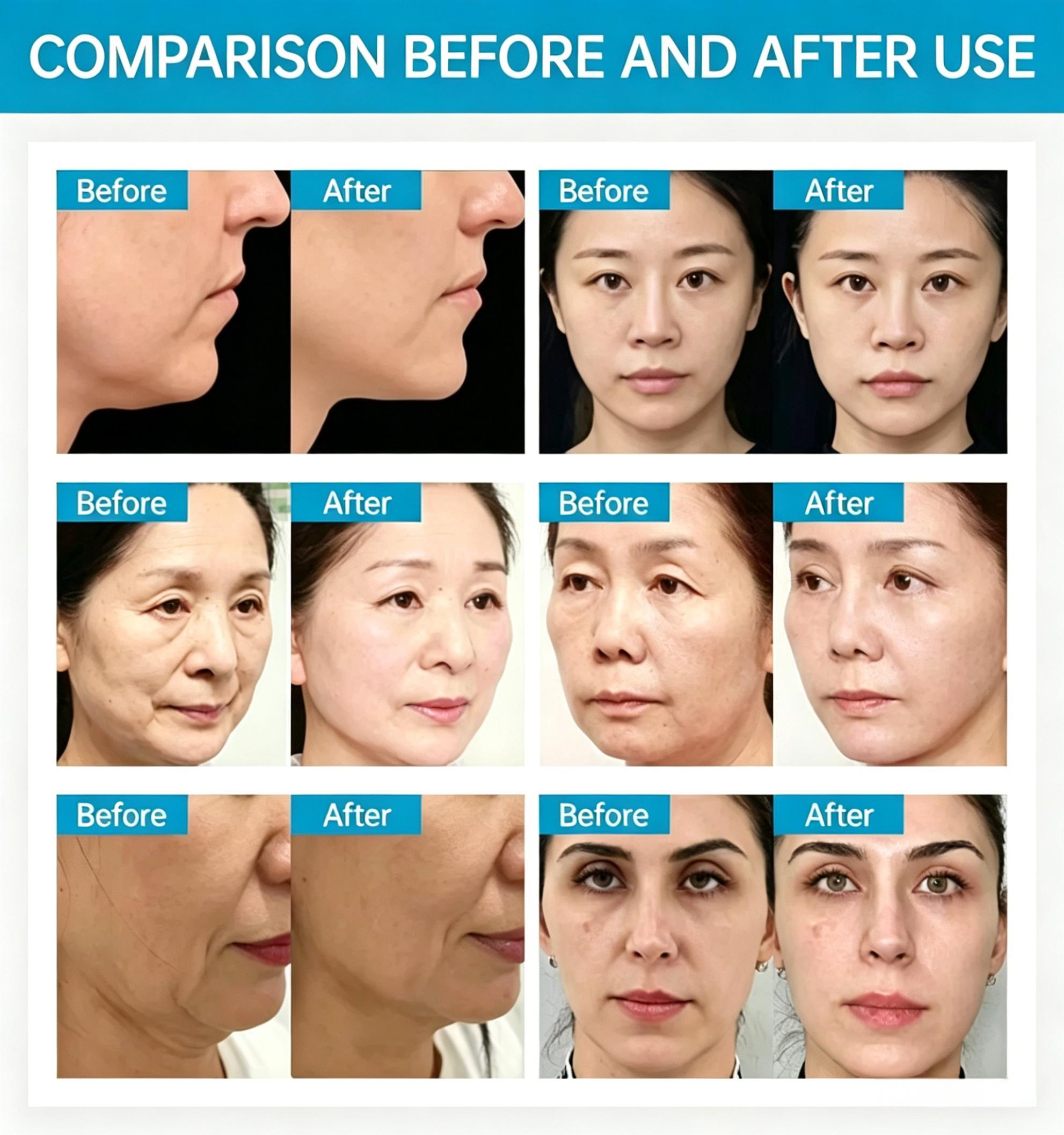 EMSnova before and after comparison showing treatment results: facial lifting, wrinkle reduction, skin tightening, and contouring improvement across 4 sets of images
